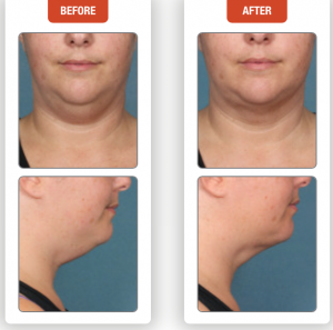 Before & After Photos of Non-surgical Neck Fat Removal With Kybella®