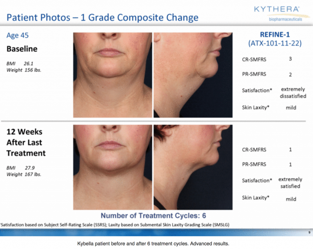 Kybella Before and After 