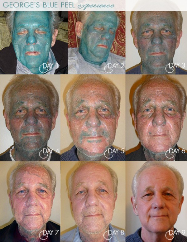 Days 1 thru 9 after getting Obagi Blue Peel