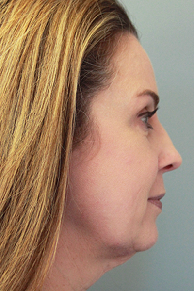 RF Microneedling & Clear + Brilliant Patient 27168 After Photo