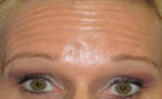 Botox Before Photo