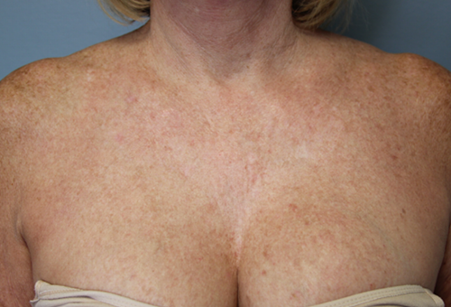 IPL Laser After Photo