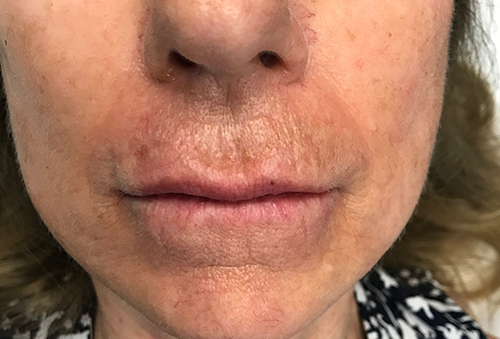 Juvéderm Ultra Plus After Photo