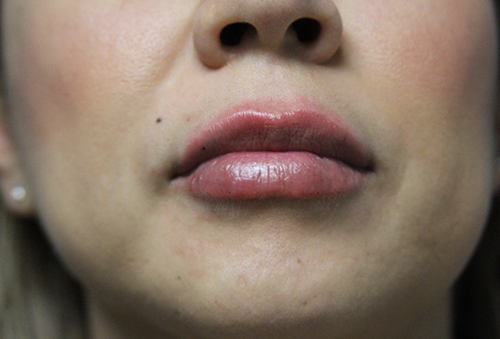 Juvederm Ultra XC After Photo