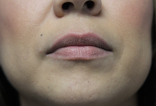 Juvederm Ultra XC Before Photo