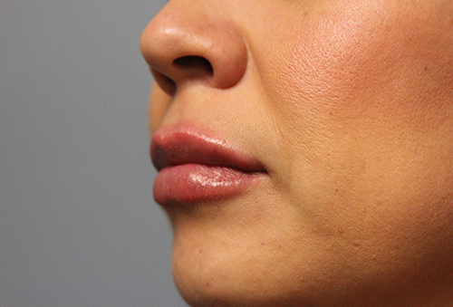 Juvederm Ultra XC After Photo