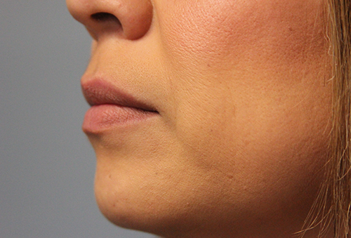 Juvederm Ultra XC Before Photo