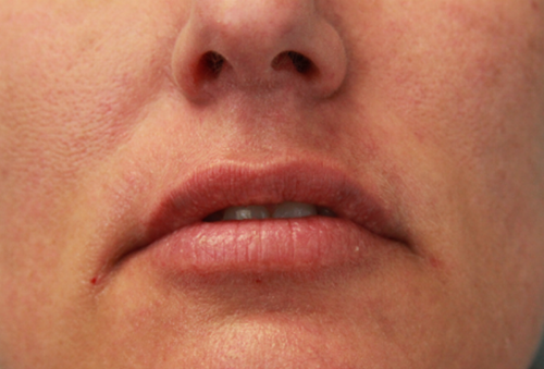 Restylane-L After Photo