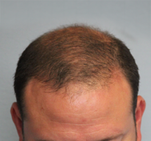 Hair Restoration After Photo