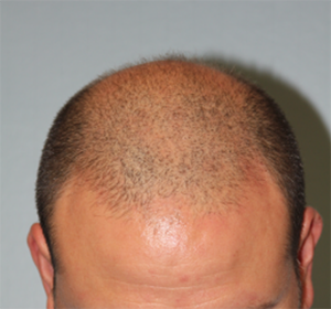 Hair Restoration Before Photo