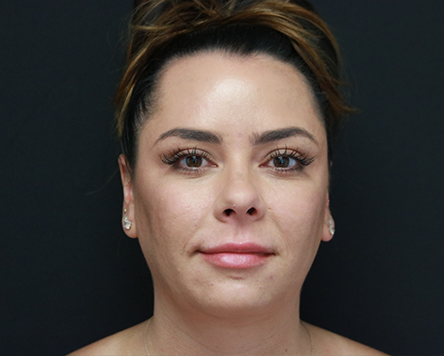 Kybella to the chin After Photo