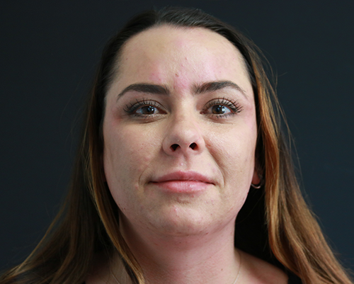 Kybella to the chin Before Photo