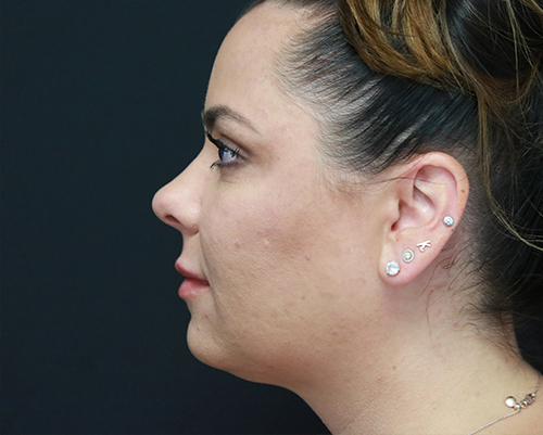 Kybella to the chin After Photo