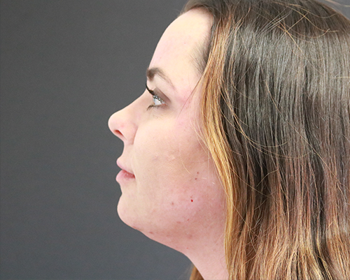 Kybella to the chin Before Photo