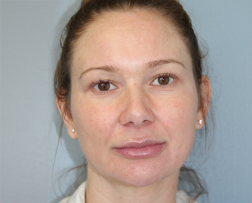 RF Microneedling After Photo