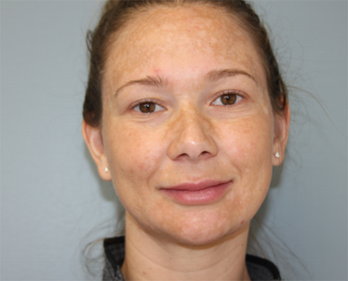 RF Microneedling Before Photo