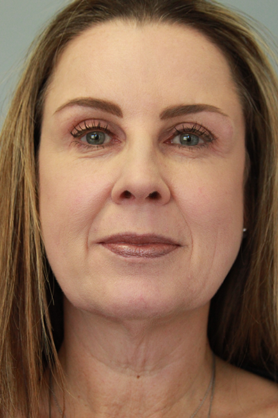 RF Microneedling & Clear + Brilliant Patient 27168 After Photo