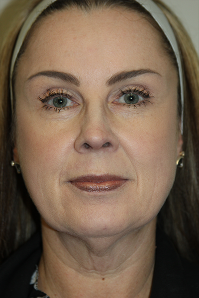 RF Microneedling & Clear + Brilliant Patient 27168 Before Photo