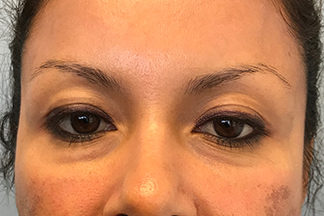 Restylane Lyft After Photo