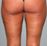 VelaShape After Photo