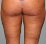 VelaShape Before Photo