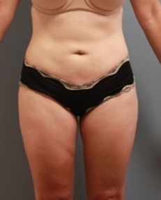 VelaShape After Photo