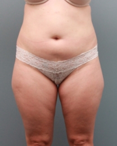 VelaShape Before Photo