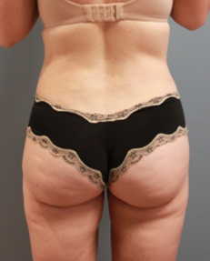 VelaShape After Photo