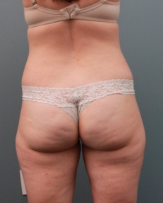 VelaShape Before Photo