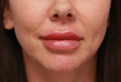 Juvederm Ultra Plus After Photo