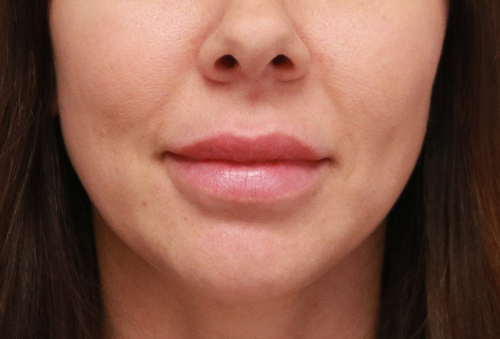 Juvederm Ultra Plus Before Photo
