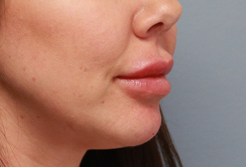 Juvederm Ultra Plus After Photo