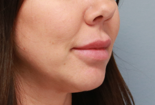 Juvederm Ultra Plus Before Photo