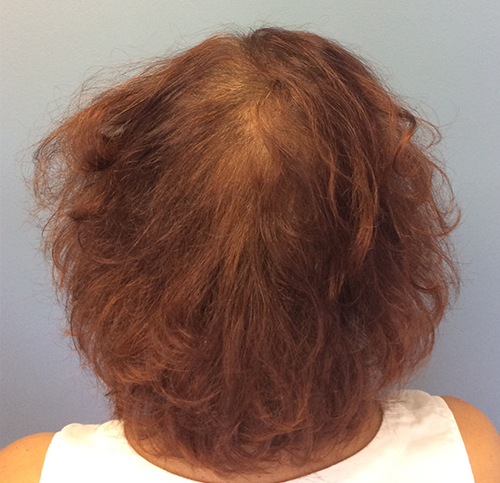 PRP Therapy for Hair Restoration After Photo