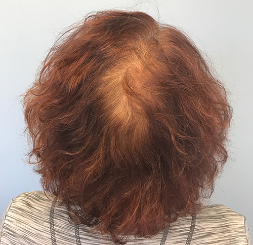 PRP Therapy for Hair Restoration Before Photo