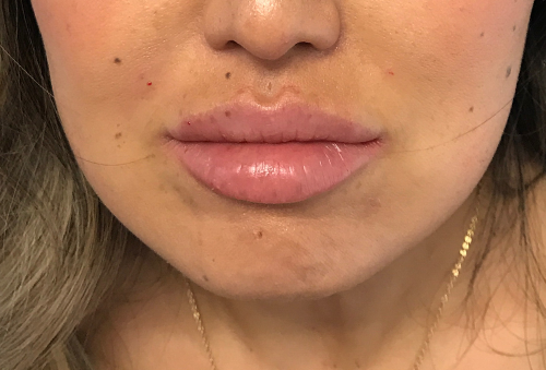 Juvederm Ultra XC After Photo