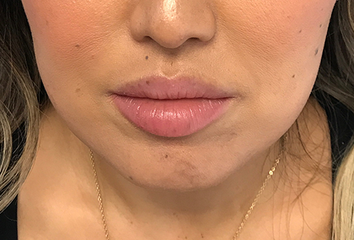 Juvederm Ultra XC Before Photo