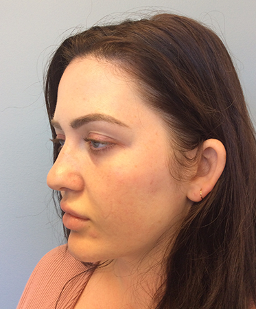 Pen Microneedling After Photo