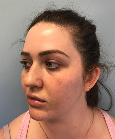 Pen Microneedling Before Photo