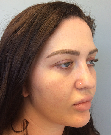 Pen Microneedling After Photo