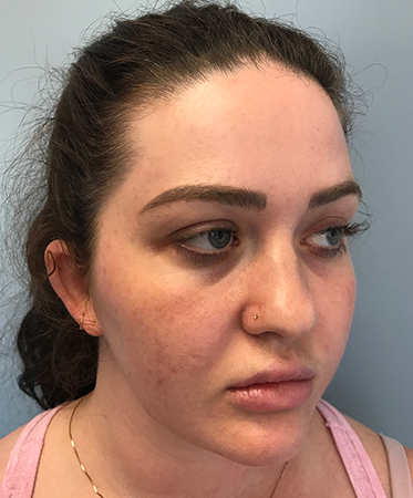 Pen Microneedling Before Photo