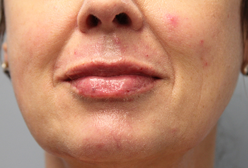 Juvederm Ultra XC Patient 27168 After Photo