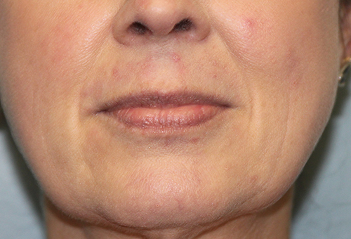 Juvederm Ultra XC Patient 27168 Before Photo