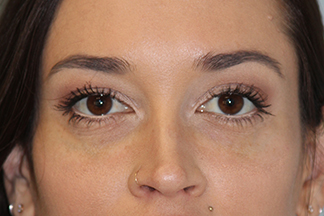 Juvederm Voluma After Photo