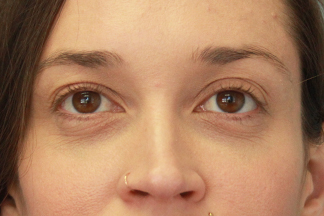 Juvederm Voluma Before Photo