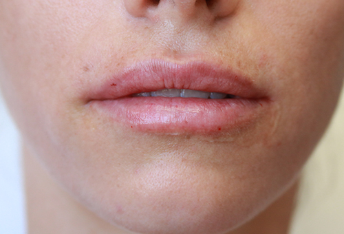 Juvederm Volbella Patient 29367 After Photo