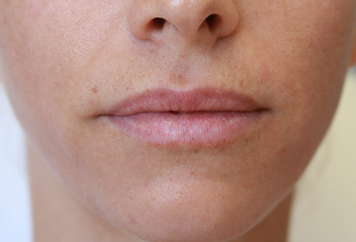 Juvederm Volbella Patient 29367 Before Photo