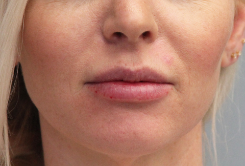 Juvederm Volbella Patient 29524 After Photo