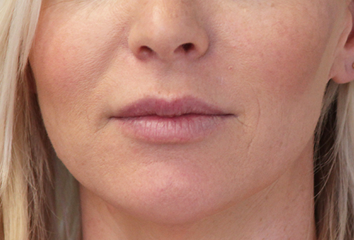 Juvederm Volbella Patient 29524 Before Photo