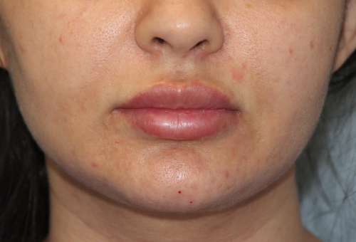 Restylane Patient 29618 After Photo